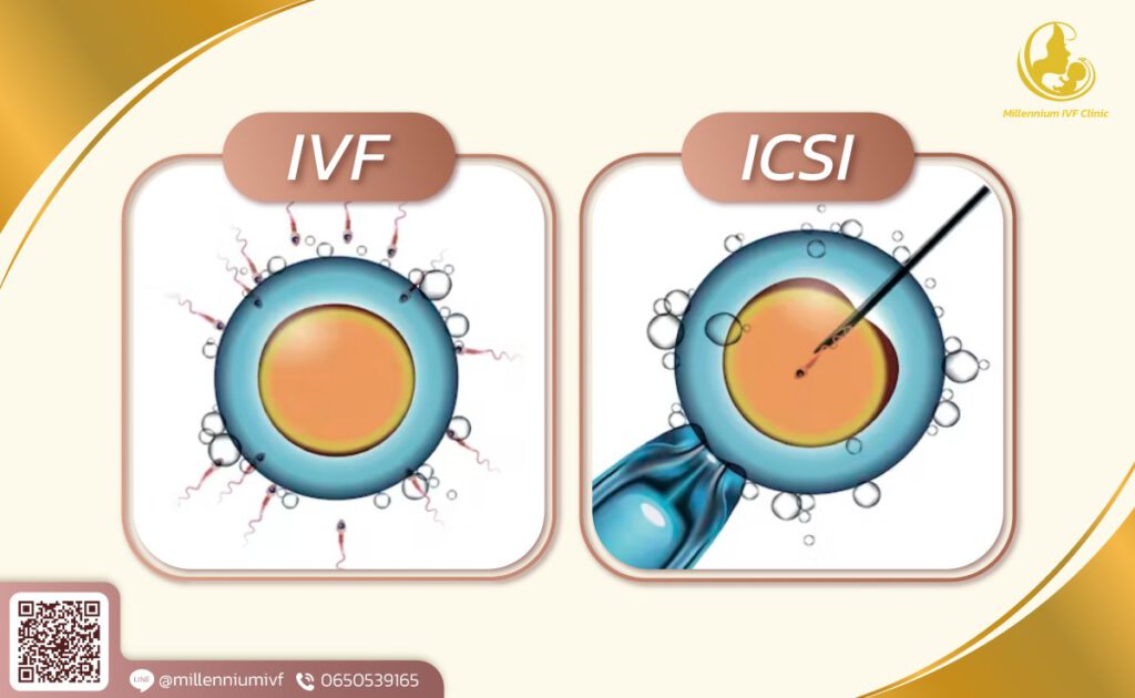 การทำ ICSI (อิ๊กซี่) กับ IVF ต่างกันอย่างไร อันไหนดีกว่ากัน Millennium IVF